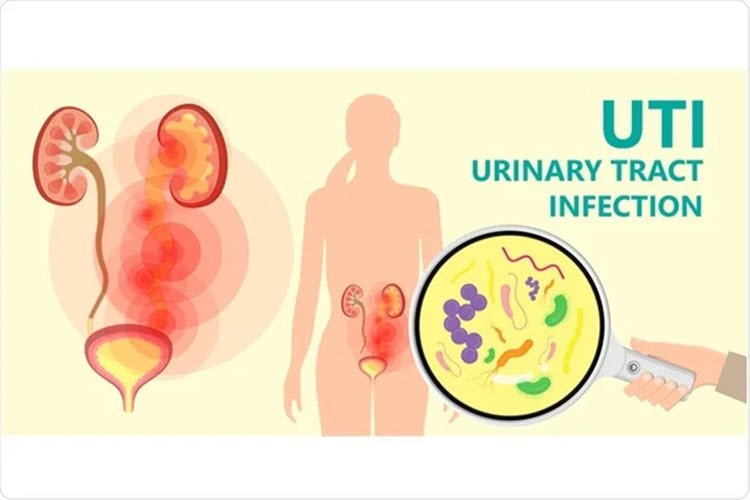 Urinary Infection Prevention, Neurogenic Bowel & SCI